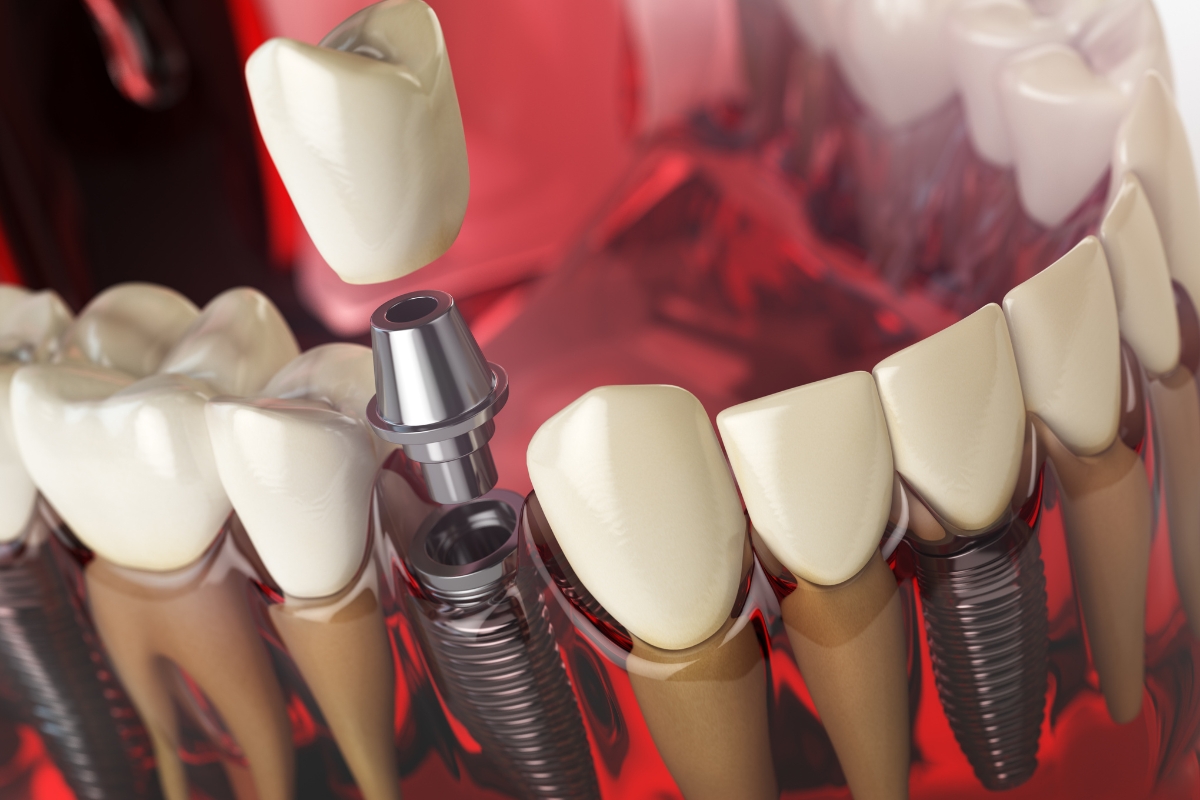 All-On-4-Implants-in-Cheney