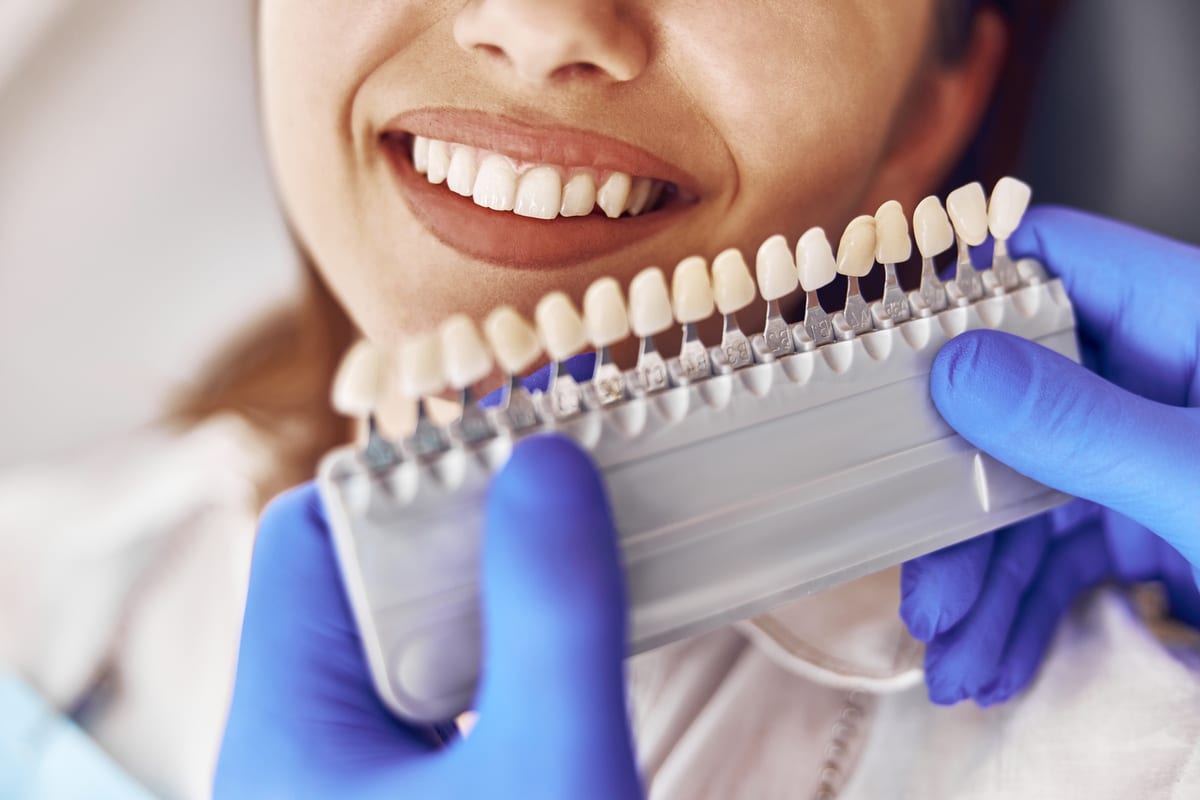 Veneers in San Jose