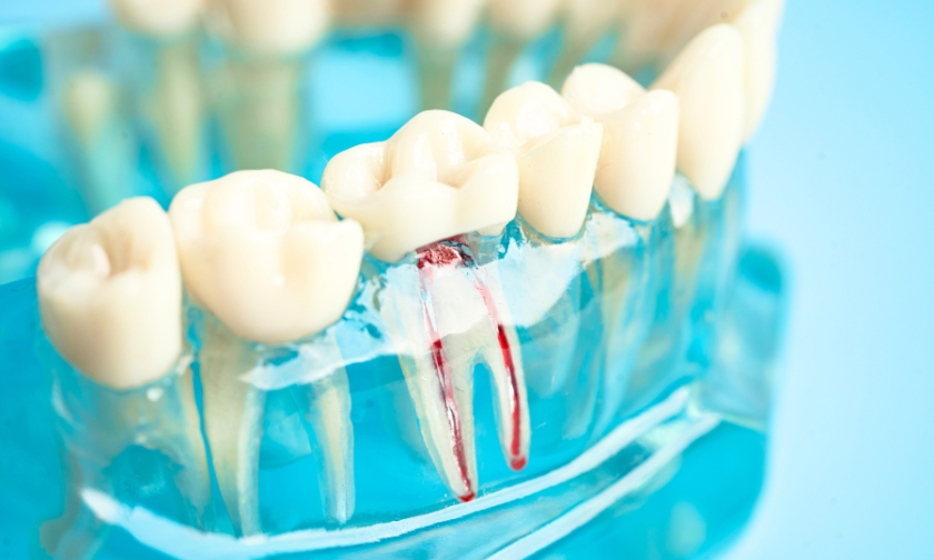 how long will a root canal last