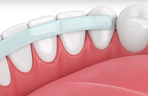 Illustration of dental bonding improving the shape and appearance of teeth