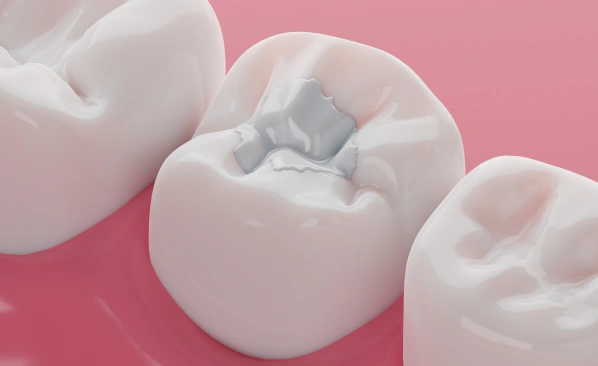 Dental filling restoring a cavity in a tooth