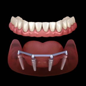 ALL-ON-4 IMPLANTS