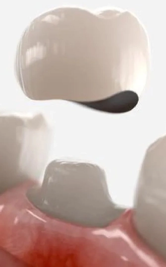 Dental Crown Austin - Cloud Dental