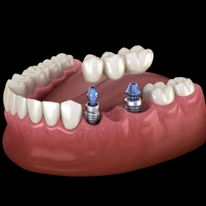 IMPLANT-SUPPORTED BRIDGES