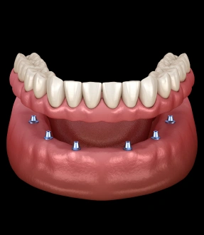 Implant Supported Dental Bridge