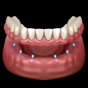 IMPLANT-SUPPORTED DENTURES