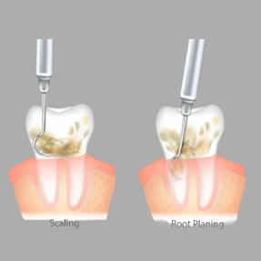 Scaling and Root Planing - Cloud Dental