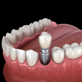 SINGLE-TOOTH IMPLANTS