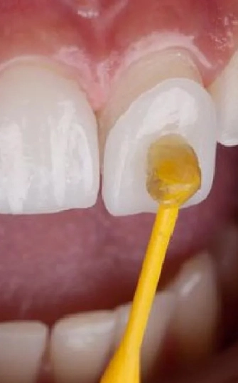 VENEER Austin - Cloud Dental