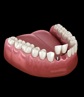 Dental crowns bridges Cantilever Dental Bridge