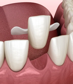 Dental crowns bridges Maryland Dental Bridge