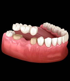 Dental crowns bridges - Traditional Dental Bridge