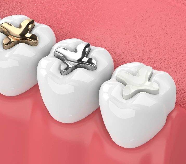 dental fillings -Cloud Dental