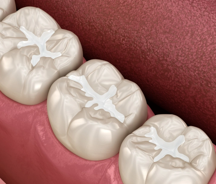 dental sealants austin - Cloud Dental