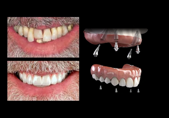 full mouth dental implants Permanent Full Mouth Implant