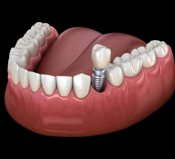 single dental implant - Cloud Dental