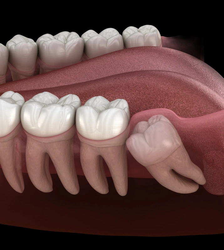 Wisdom Teeth Extraction Austin - Cloud Dental
