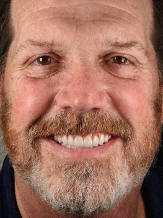 Smile Transformations After