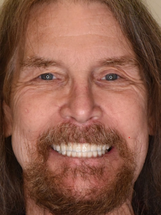 Smile Transformations After