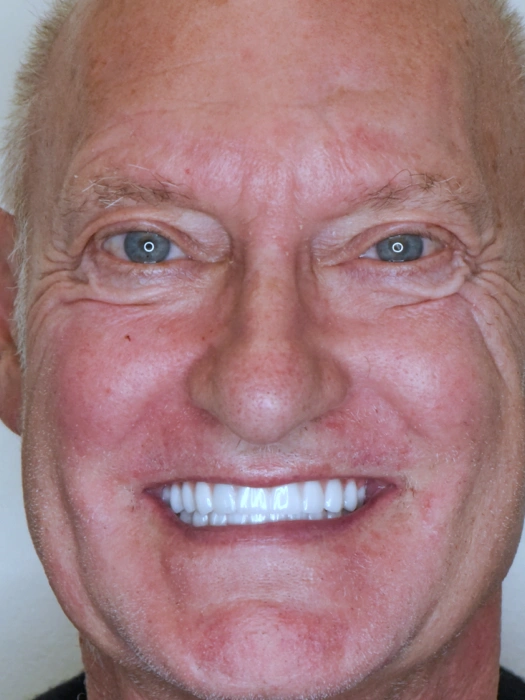 After Smile Transformations