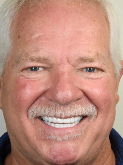 After Smile Transformations