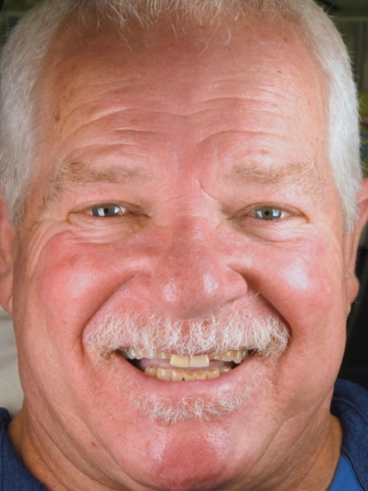 Smile Transformations before