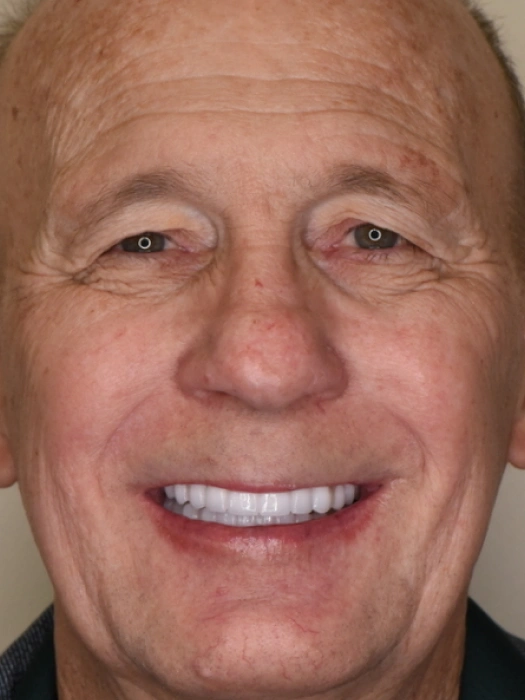 After Smile Transformations