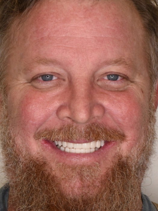 Smile Transformations After