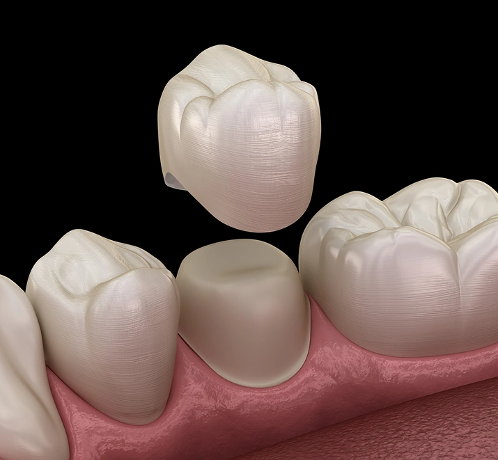 Dental Crowns Austin - Cloud Dental