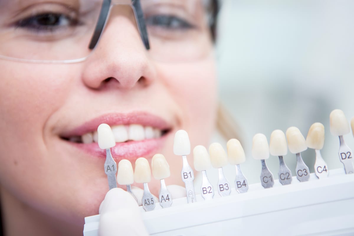 Veneers in Austin