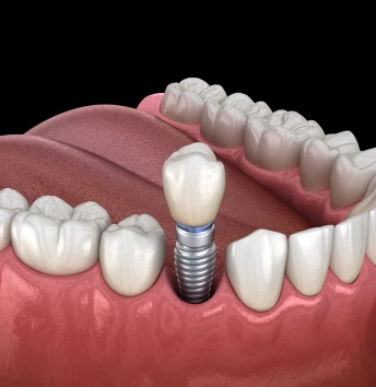 Single-Tooth Dental Implants