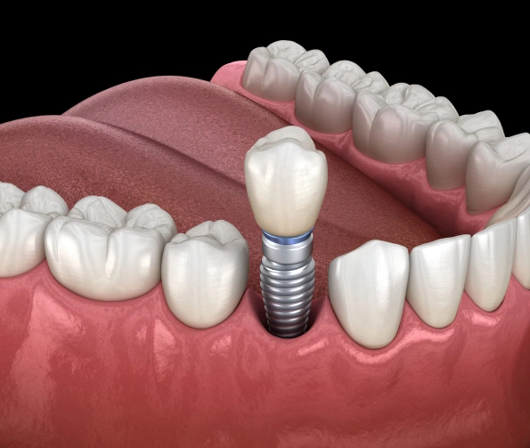 Understanding Single-Tooth Implants