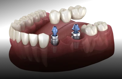 Implant-Supported Bridges