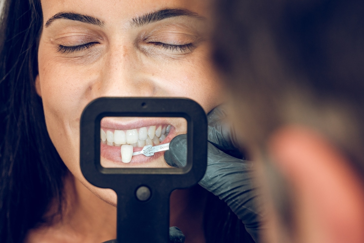 veneers in Utah