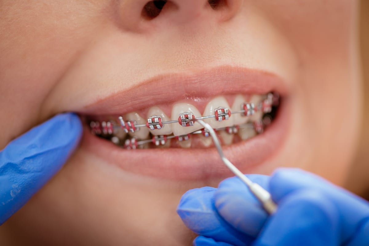 Tooth Colored Fillings in West Jordan