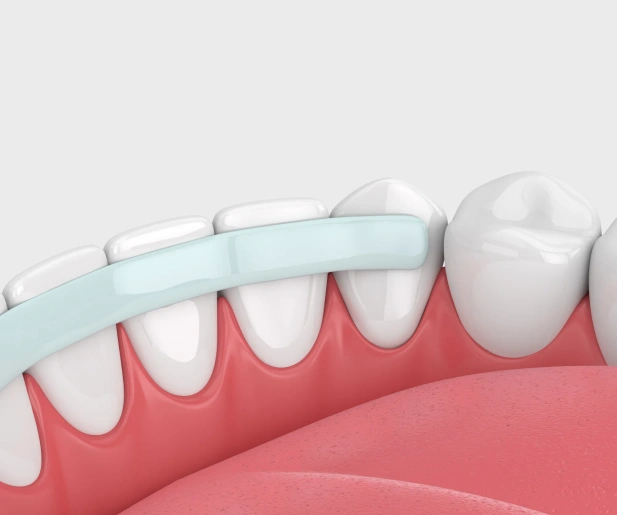 dental bonding service in covina, ca