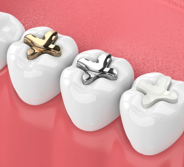 dental filling in covina, ca