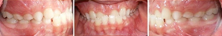 Close up front view of a patient's teeth before orthodontic treatment at Cranston Orthodontics