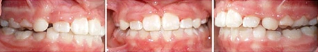 Close up front view of a patient's teeth after orthodontic treatment at Cranston Orthodontics