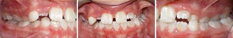 Close up front view of a patient's teeth before orthodontic treatment at Cranston Orthodontics