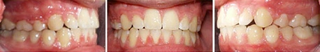 Close up front view of a patient's teeth after orthodontic treatment at Cranston Orthodontics