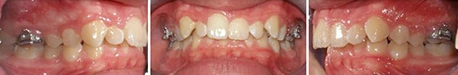 Close up front view of a patient's teeth before orthodontic treatment at Cranston Orthodontics