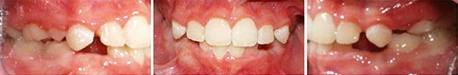 Close up front view of a patient's teeth after orthodontic treatment at Cranston Orthodontics