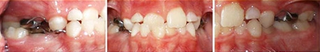 Close up front view of a patient's teeth before orthodontic treatment at Cranston Orthodontics