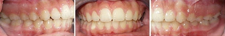 Close up front view of a patient's teeth after orthodontic treatment at Cranston Orthodontics