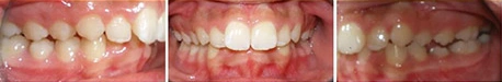 Close up front view of a patient's teeth before orthodontic treatment at Cranston Orthodontics