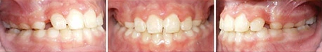 Close up front view of a patient's teeth after orthodontic treatment at Cranston Orthodontics