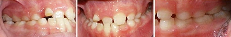 Close up front view of a patient's teeth before orthodontic treatment at Cranston Orthodontics
