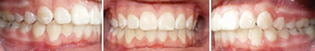 Close up front view of a patient's teeth after orthodontic treatment at Cranston Orthodontics