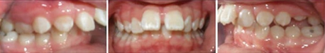 Close up front view of a patient's teeth before orthodontic treatment at Cranston Orthodontics
